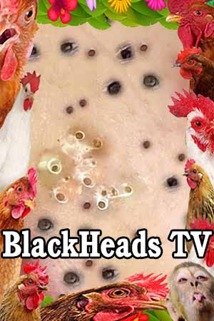 Blackheads Season 1